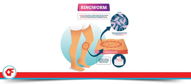 Urgent Care for Ringworm Near Me Davie FL